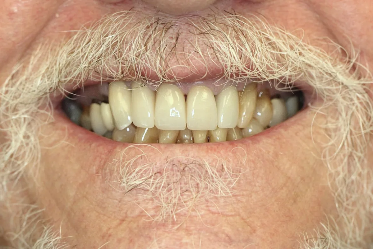 Front Teeth Restoration: after treatment
