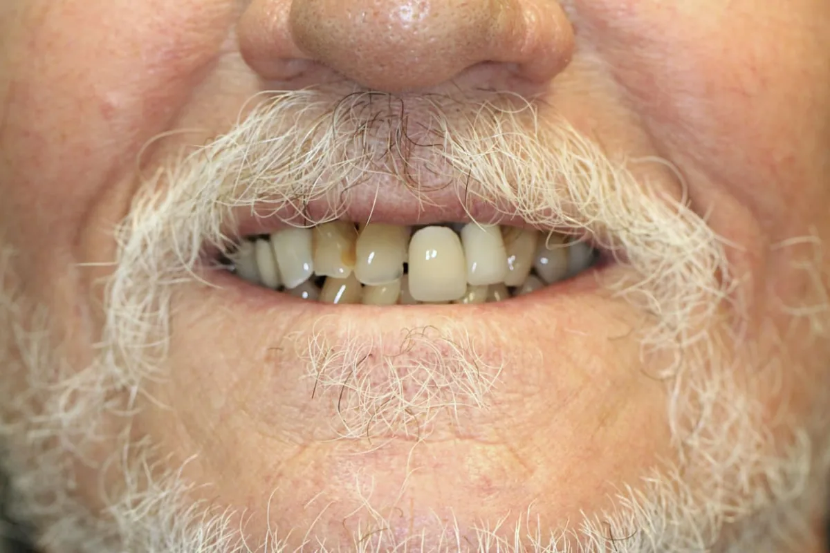 Front Teeth Restoration: before treatment