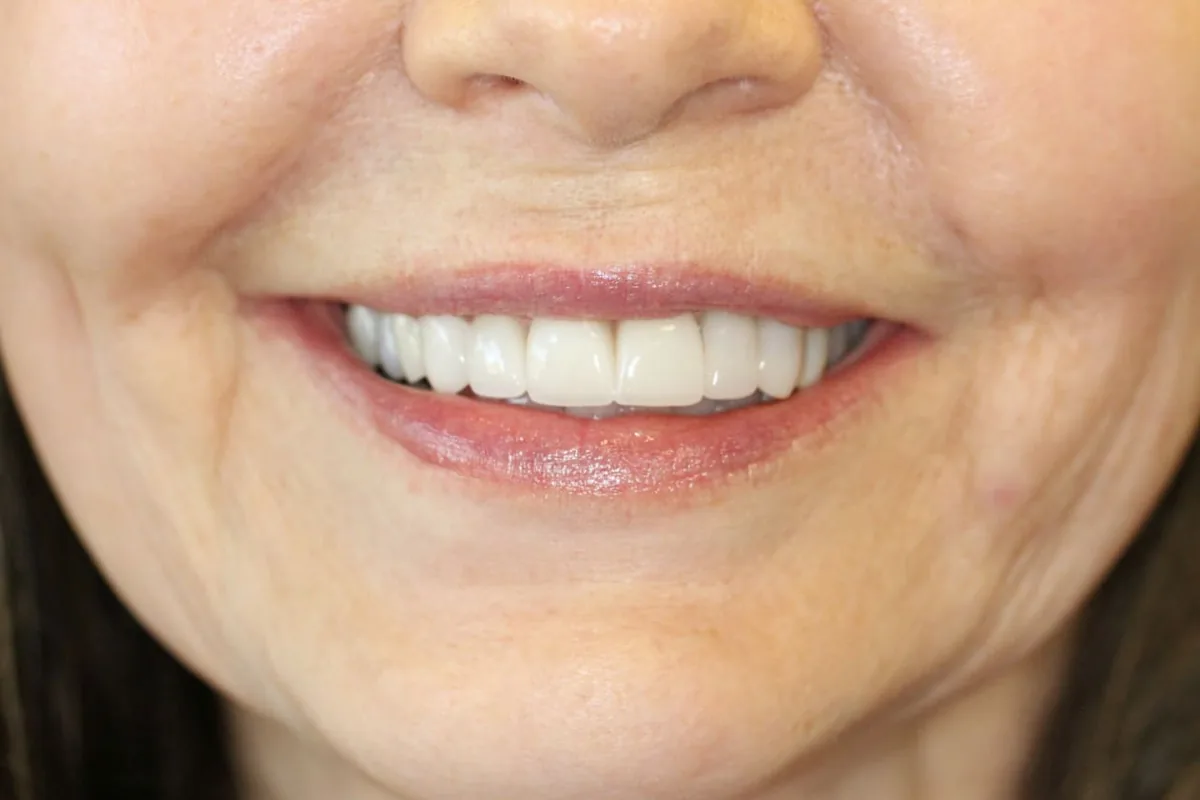 Cosmetic Smile Makeover: after treatment