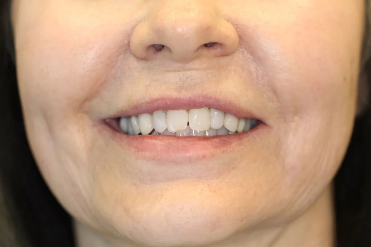 Cosmetic Smile Makeover: before treatment