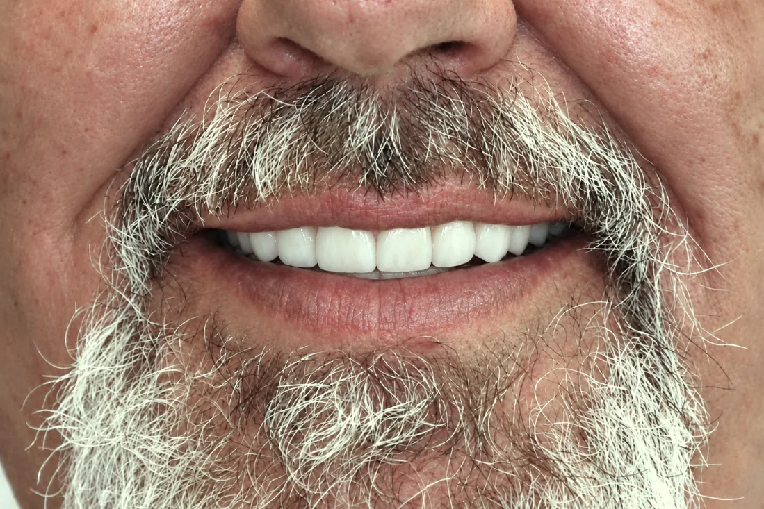 Denture Transformation: after treatment