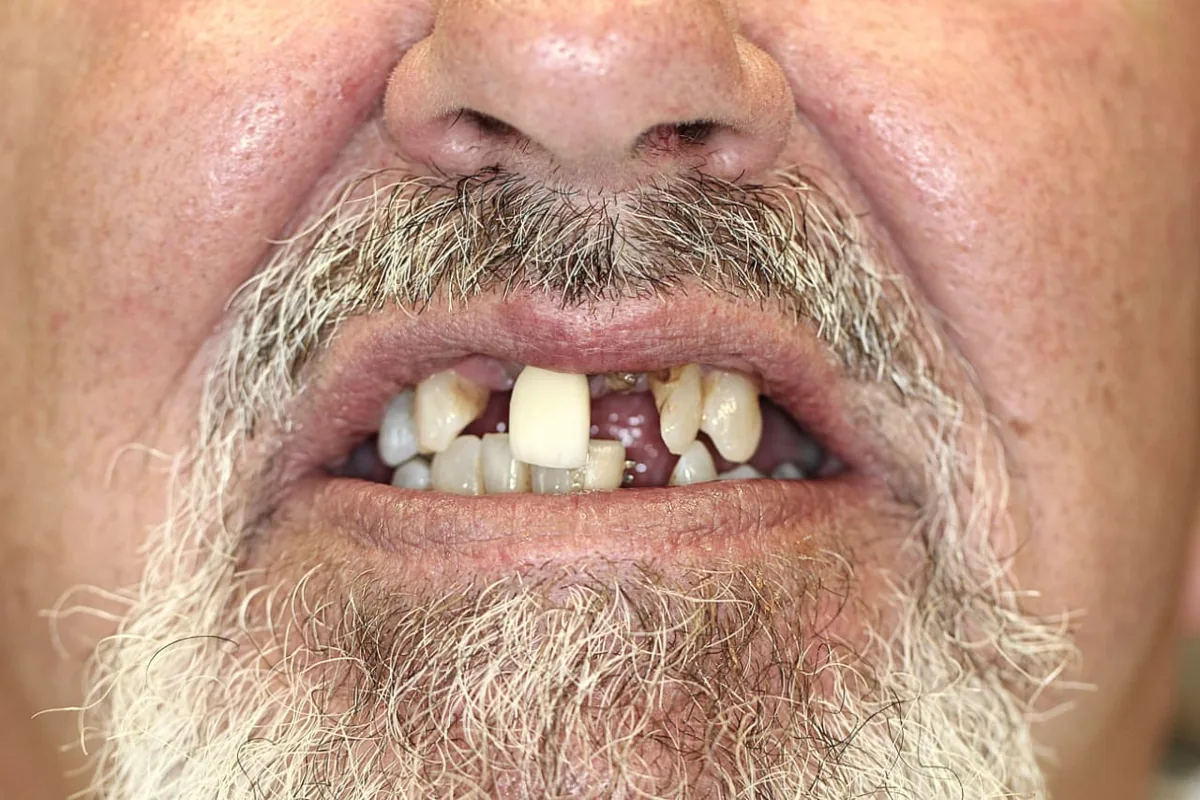 Denture Transformation: before treatment